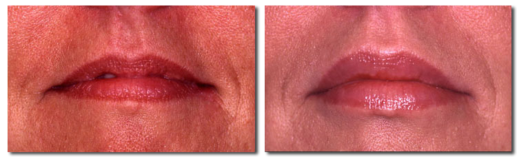 Fat Injection Pictures