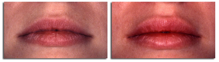 Fat Injection Pictures