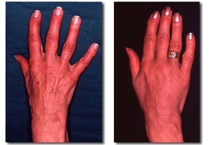 Fat Injection Pictures