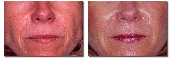 Fat Injection Pictures